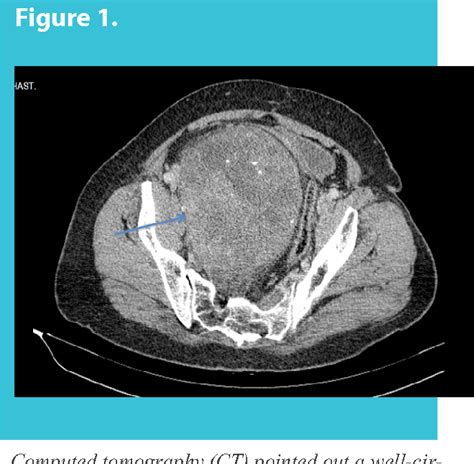 Figure From Giant Schwannoma Of The Pelvis A Case Report Semantic