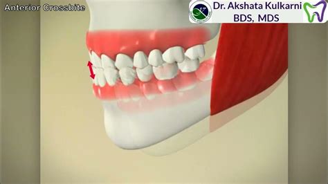 Anterior Crossbite Youtube