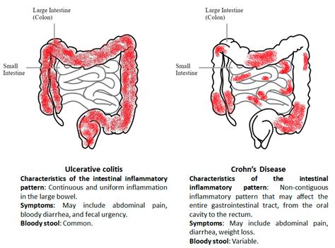 Crohns Disease Stool