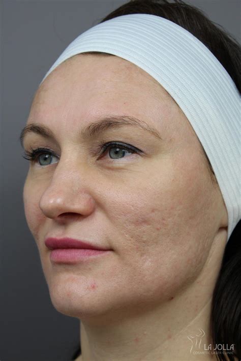 Acne Scars Before After Gallery Patient 5