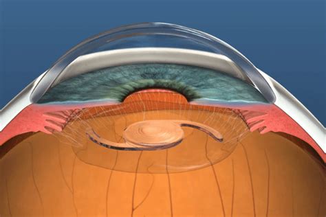 What is Refractive Lens Exchange (RLE) and Its Advantages