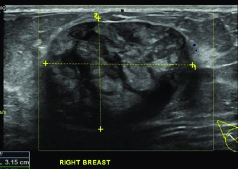 Ultrasound demonstrates a solid 4.25 x 3.3 x 2.4 cm well-circumscribed ...