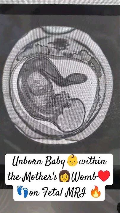 Unborn Baby 👶within The Mothers Womb👩♥️ On Fetal Mri😎 Ytshorts Viral