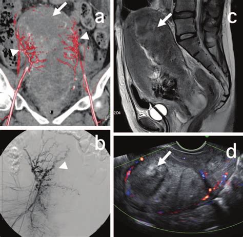 Image Diagnostic Findings Of Retained Placenta Accreta Causing