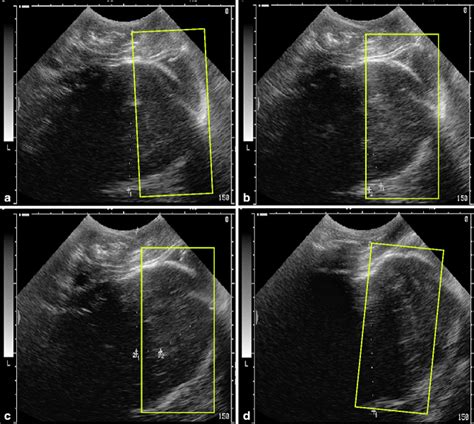 Intrapartum Translabial Ultrasound With Contractions Illustrating A