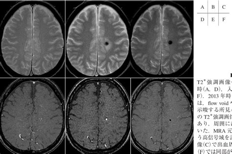 Figure From A Case Of Moyamoya Disease Related Peripheral Aneurysm