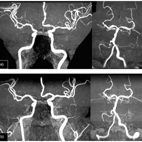 Pdf Reversible Cerebral Vasoconstriction Syndrome An Under Recognized Clinical Emergency