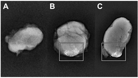 Jcm Free Full Text Ct Lymphography Using Lipiodol® For Sentinel