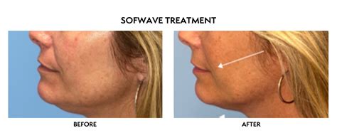 Sofwave Skin Tightening North Bethesda Md North Bethesda Md