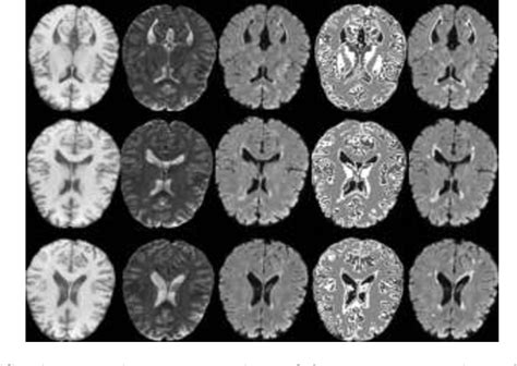 Figure 2 From Automatic Segmentation Of Multiple Sclerosis Lesions In Brain Mr Images Semantic