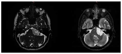 Ijerph Free Full Text Intracranial Epidermoid Cyst Mimics