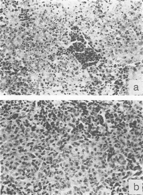 Photomicrographs Showing Severe Splenic Necrosis Caused By The