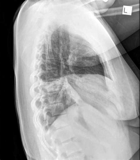 Pneumonia Lateral Chest X Ray