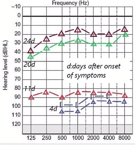 Pure Tone Audiogram Presenting The Course Of Hearing Improvement From