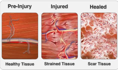 Regeneration Of Injured Skeletal Muscle After The Injury A Foot Above