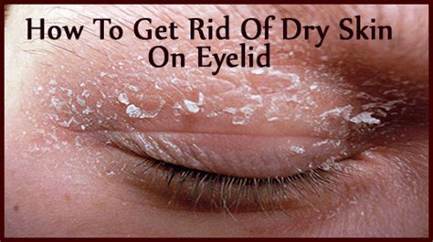 5 Ways To Relieve Dry Skin On Eyelids Naturally In No Time Dry Eye Remedies Dry Eyelids