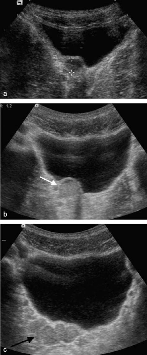 Ultrasound (a) at the age of 4 years detects a right retrovesical ...