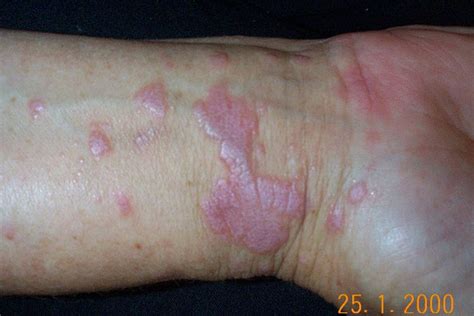 Chronic Plaque Psoriasis: Home Remedies, OTC, Prescriptions