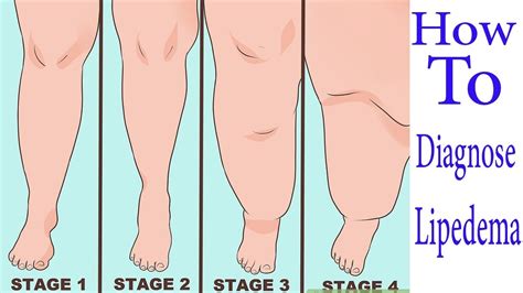 Diagnose Lipedema How To Diagnose Lipedema Youtube