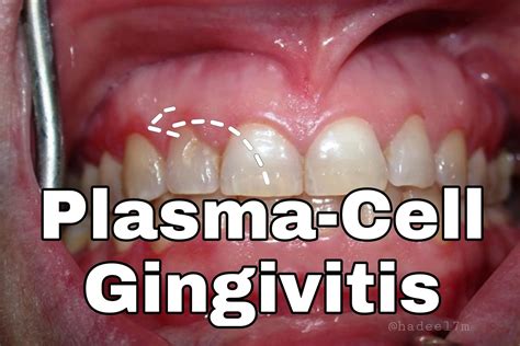 Plasma Cell Gingivitis