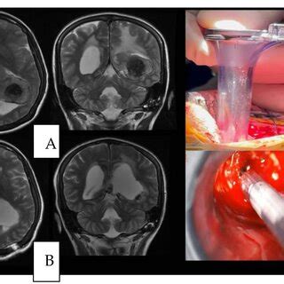 A Axial And Coronal View Of A Preoperative T Weighted Mri B The