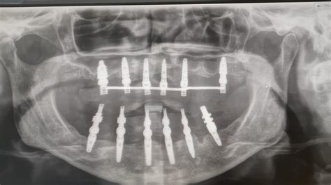 Implantes de Carga Inmediata Qué son y ventajas Santident