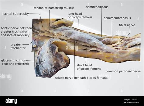 Dissection Image Of The Muscle Of The Thigh With Showing Sciatic Nerve