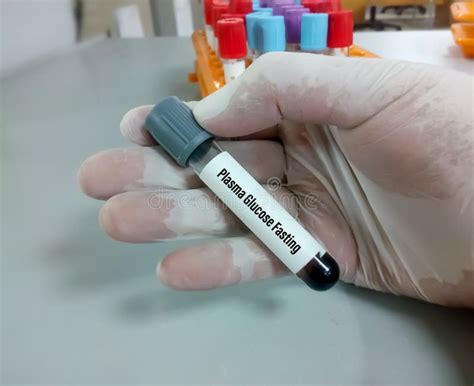 Scientist Hold A Sample Tube Of Plasma Glucose Fasting FGP Test To