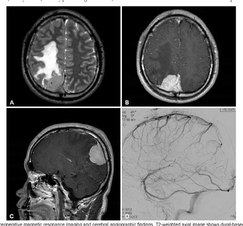 Figure 1 From Failed First Craniotomy And Tumor Removal Of Parasagittal Meningioma With Severe