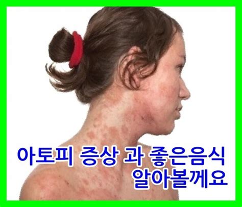 아토피증상 과 아토피에 좋은 음식