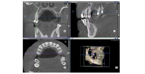 Sections Mm Of Cbct D Images Denoted By Axial Coronal And