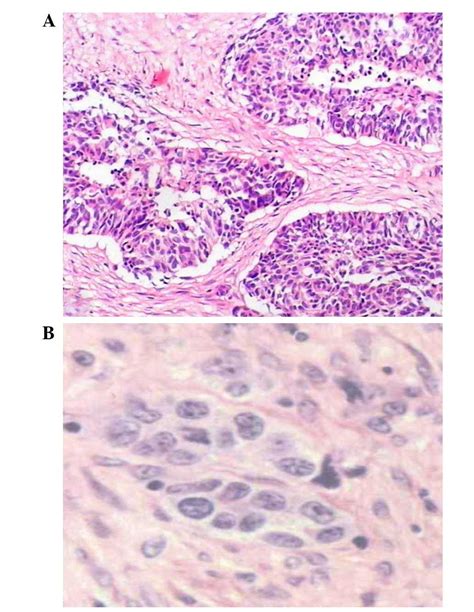 Complete Response Of Giant Desmoplastic Small Round Cell Tumor Treated