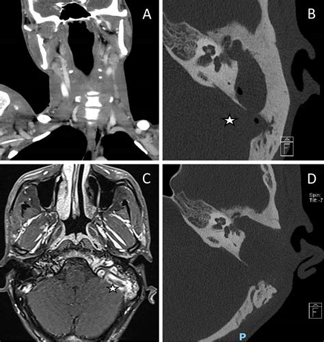 Otogenic Lemierres Syndrome With Bilateral Metastatic Pneumonia