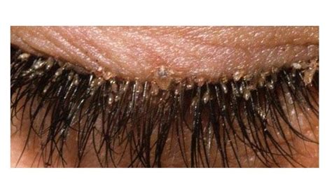 We All Have Mites In The Eyelashes And Here S How To Get Rid Of Them