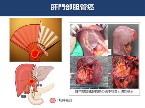 癌 手術