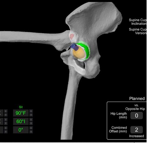 Robotic Hip Replacement