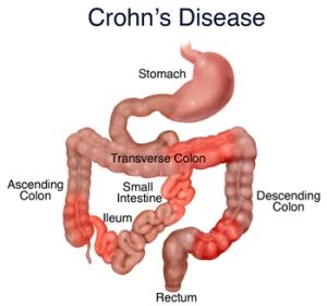 Crohn’s disease – Dr Renu Madan