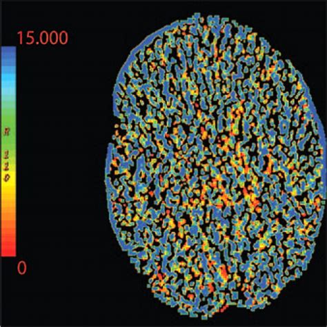 Imaging Of Stroke Part Perfusion Ct Overview Of Imaging Technique