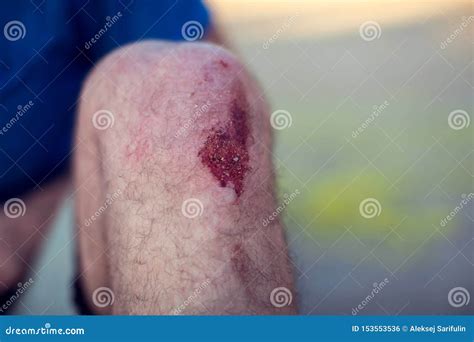 Emergency Accident Open Abrasion Wound Trauma Skin Leg Knee Stock Photo