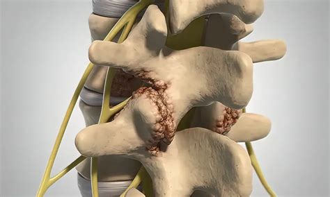 Medial Branch Blocks for Knoxville, TN | Pain Medicine of the South ...