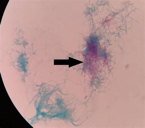 Modified Ziehl-Neelsen staining revealed acid-fast filamentous bacteria ...