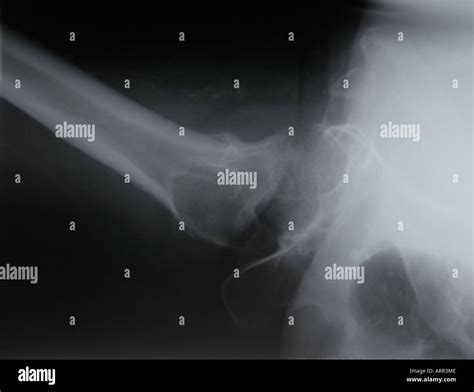 cross table lateral radiograph