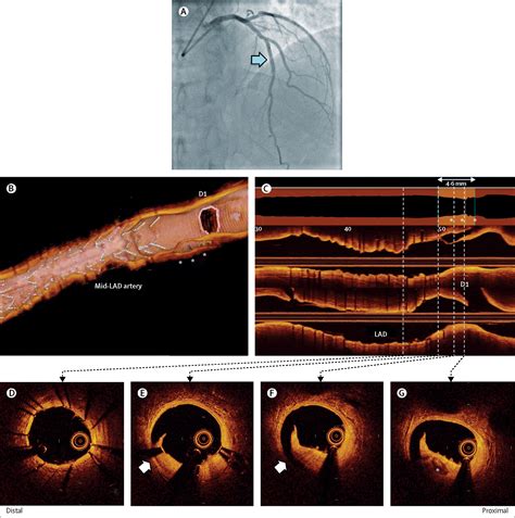 Intravascular Imaging In Coronary Artery Disease The Lancet