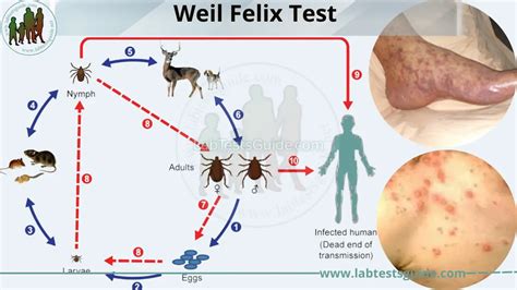 Weil Felix Test Understanding Its Purpose Procedure And Results