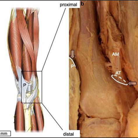 Demonstrating Anatomical Landmarks For Acb On The Knee Prosection A Download Scientific