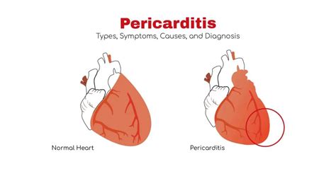 Pericarditis: Types, Symptoms and Diagnosis ~ Stat Cardiologist