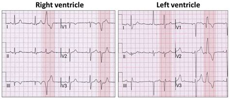 The Electrocardiographic Footprints Of Ventricular Ectopy Heart Lung