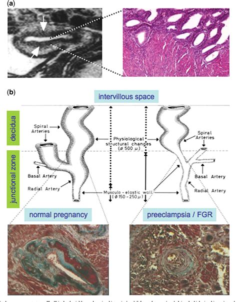 Figure 1 From Defective Myometrial Spiral Artery Remodelling As A Cause