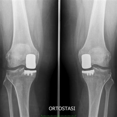 Protesi Bilaterali Di Anca E Ginocchio Studio Ortopedico Pytheas