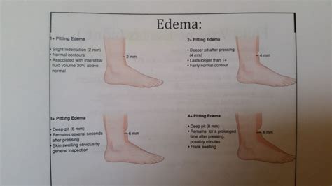 Edema Rating Scale